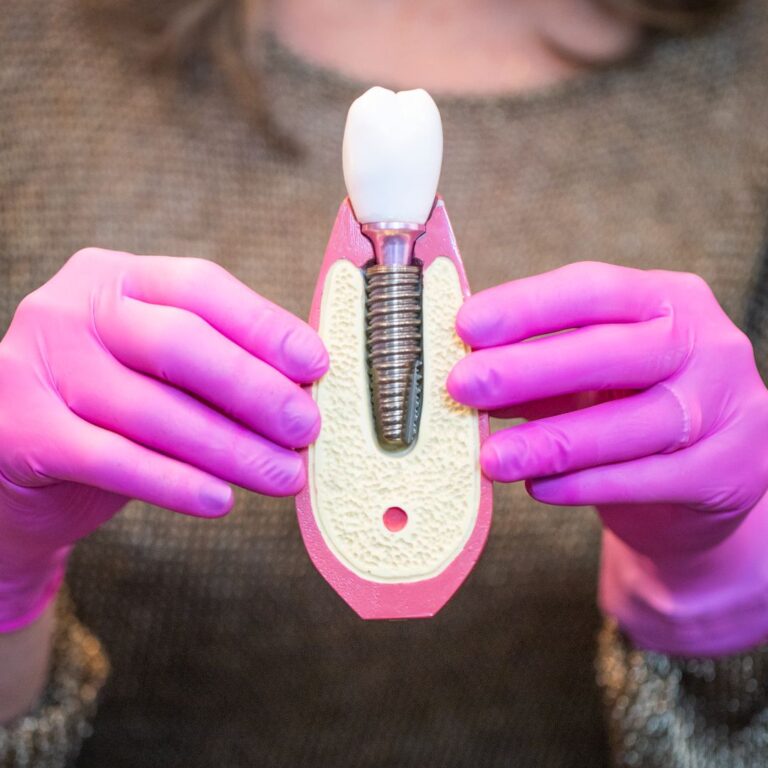 Modelo de Implante Dentário